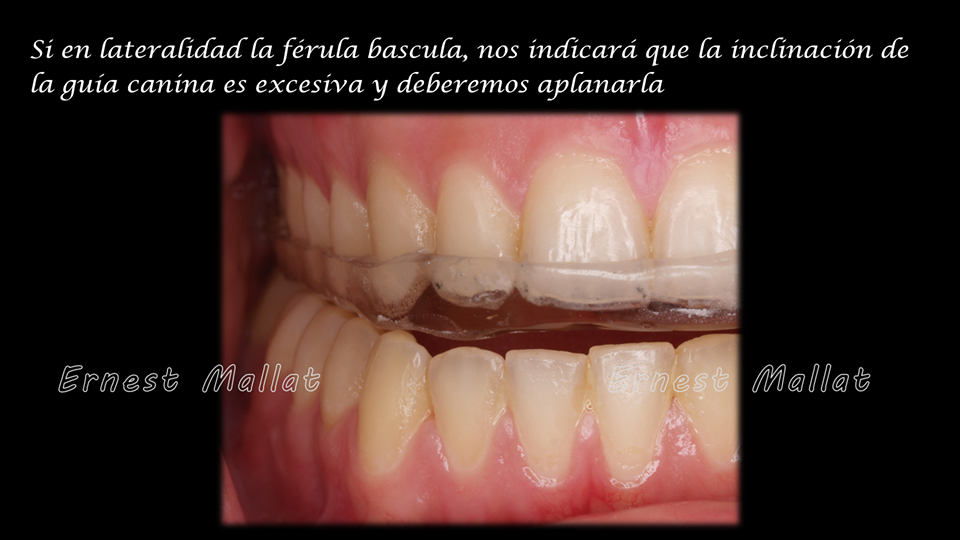 Férulas de descarga: ¿superior o inferior? - Diagonal Clinic Dental